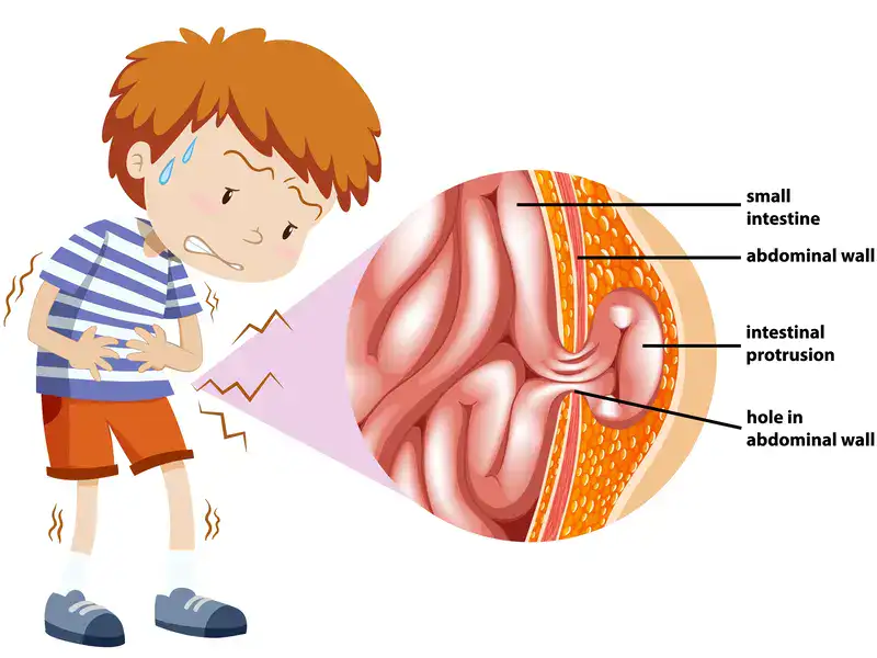 laparoscopic hernia surgery in indore, laparoscopic hernia treatment in indore