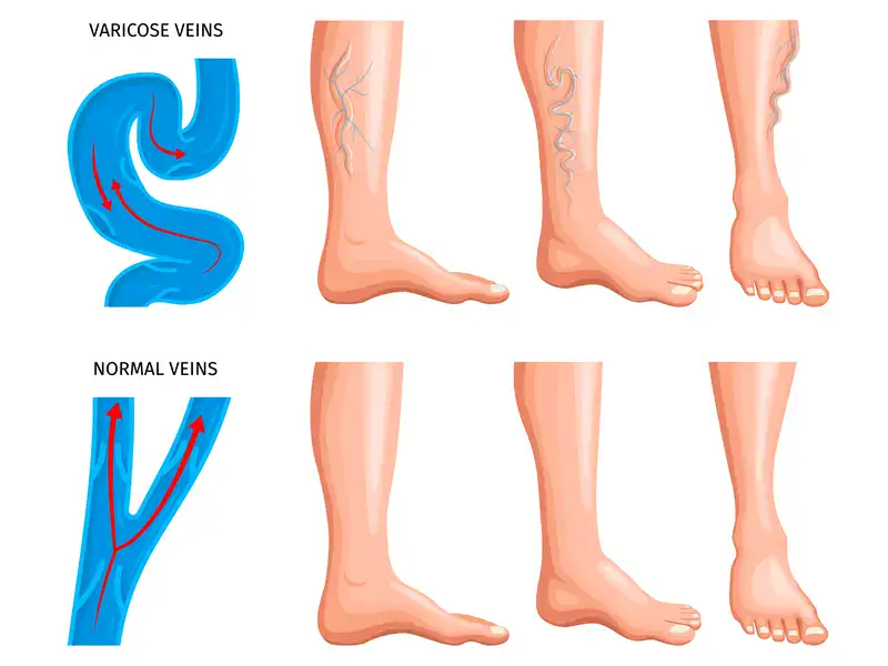 varicose vein treatment in indore, vascular disease treatment in indore, dr rassiwala