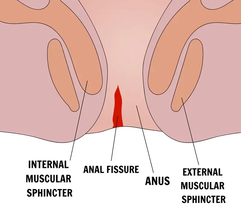 fissure treatment in indore, fissure doctor in indore