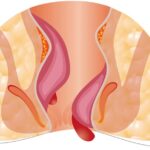 Advanced laser treatment for piles, fissure, and fistula