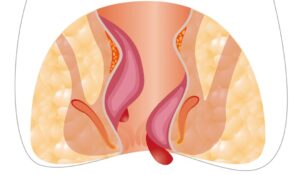 Advanced laser treatment for piles, fissure, and fistula