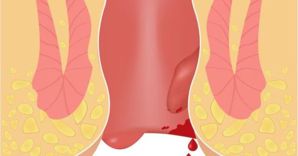 bavasir specialist in indore, bavasir doctor in indore