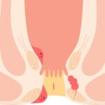 laser surgeon in indore, bavasir specialist in indore, piles doctor in indore