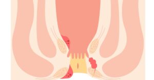 laser surgeon in indore, bavasir specialist in indore, piles doctor in indore