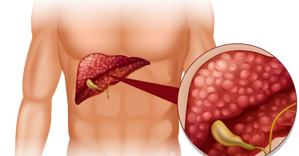 laparoscopic gallbladder surgery in indore