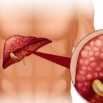 laparoscopic gallbladder surgery in indore