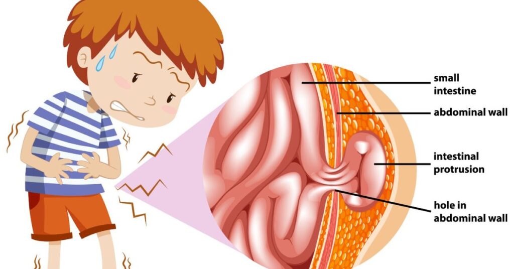 hernia surgery in indore, hernia doctor in indore