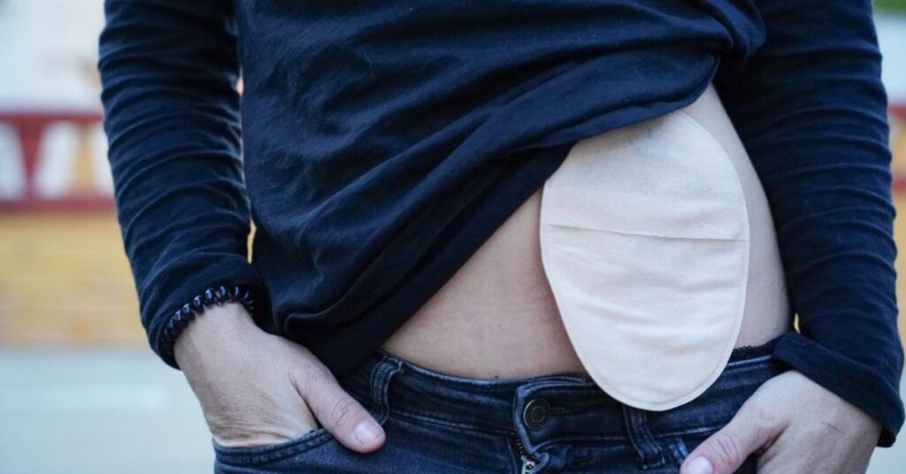 hernia surgery with the best hernia doctor in Indore