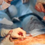 hernia surgery in indore illustration showing laparoscopic and open surgery procedure