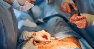 hernia surgery in indore illustration showing laparoscopic and open surgery procedure