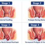 Piles stages diagram showing stage 1 to stage 4 with symptoms like bleeding, pain, swelling and best piles treatment guidance in Indore