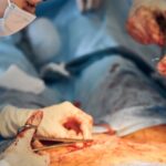 इंदौर में लैप्रोस्कोपिक हर्निया सर्जरी (laparoscopic hernia surgery in indore)