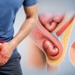 Inguinal Hernia Treatment