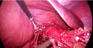 Laparoscopic Hiatal Hernia Repair with Nissen Fundoplication in a 55-Year-Old Female