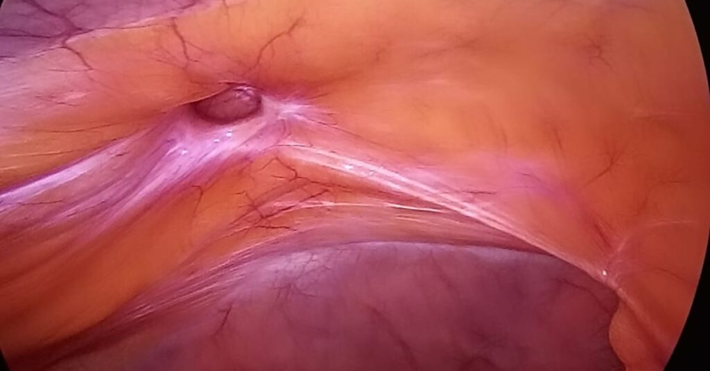 Laparoscopic Ventral Hernia Surgery in an 81-Year-Old Female
