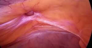 Laparoscopic Ventral Hernia Surgery in an 81-Year-Old Female