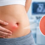 Umbilical Hernia Treatment in Indore