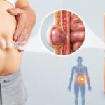 hernia surgeon in indore
