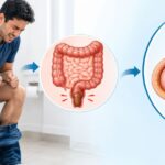 hernia surgery