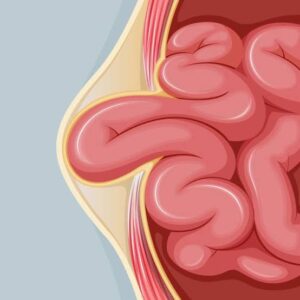 Illustration of intestine pushing through the abdominal wall in a hernia