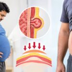 Obesity and Hernia