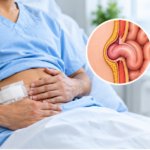 Hernia Surgery Complications