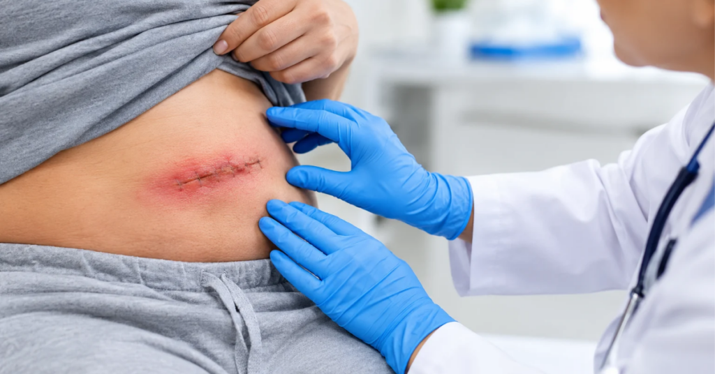 Post-Operative Infection Signs