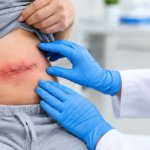 Post-Operative Infection Signs